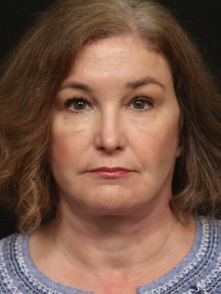 Facelift Before And After After