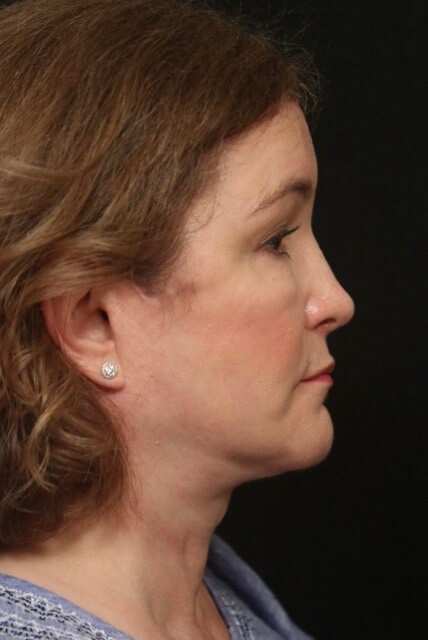 Facelift Before And After After