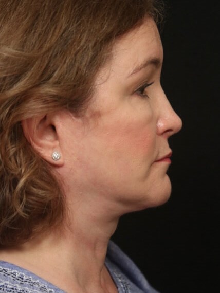 Facelift Before And After After