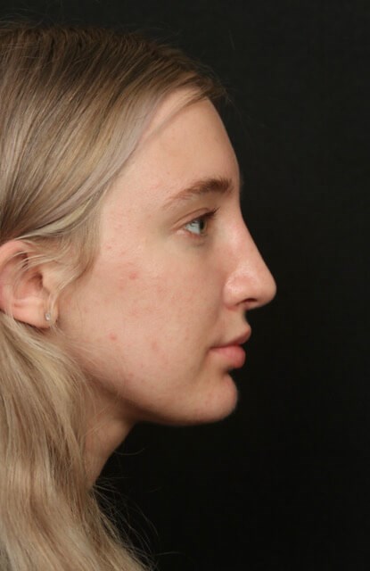 Rhinoplasty Before and After After