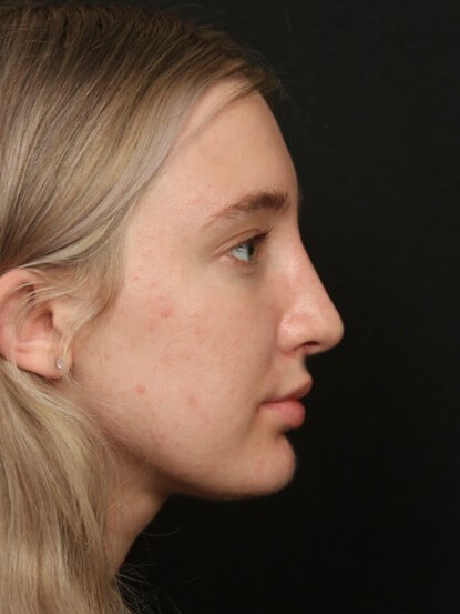 Rhinoplasty Before and After After