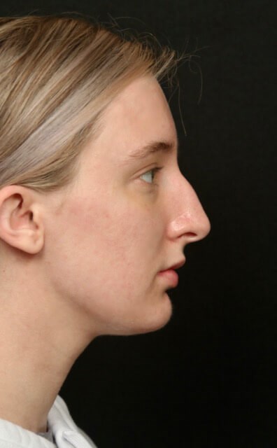 Rhinoplasty Before and After Before