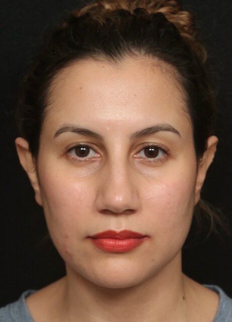 Rhinoplasty Before and After Before