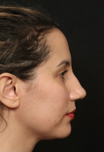 Rhinoplasty Before and After Before