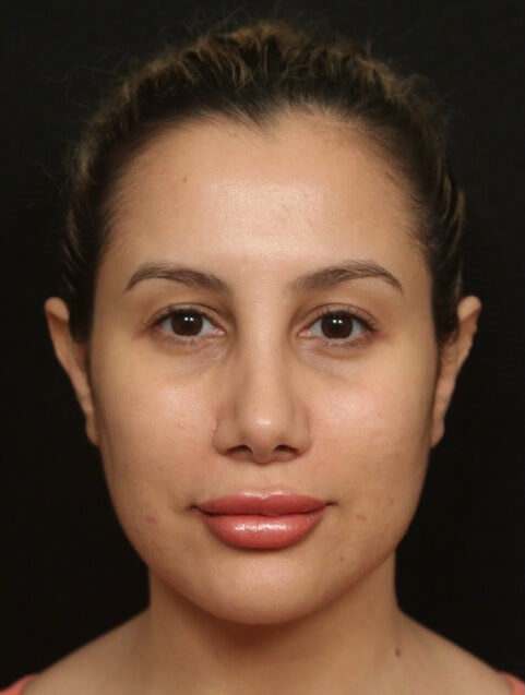 Rhinoplasty Before and After After