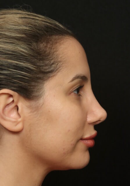 Rhinoplasty Before and After After