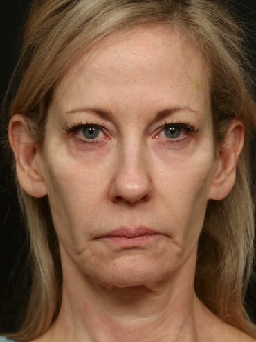Face/Neck Lift Before & After Before