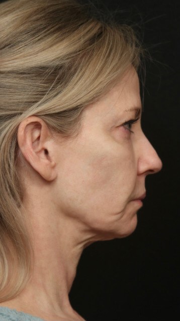 Face/Neck Lift Before & After Before