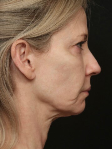 Face/Neck Lift Before & After Before
