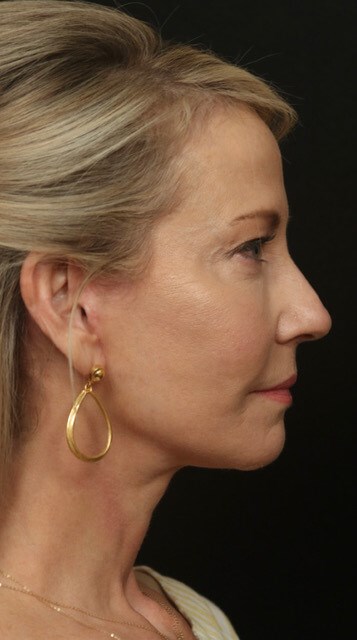 Face/Neck Lift Before & After After