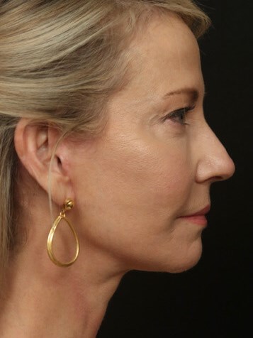 Face/Neck Lift Before & After After
