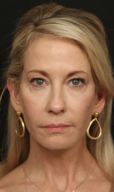 Face/Neck Lift Before & After After