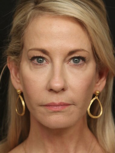 Face/Neck Lift Before & After After