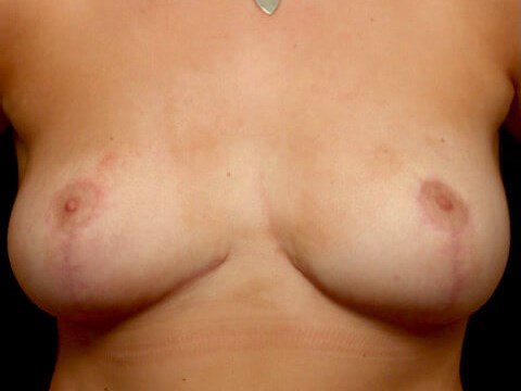 Breast Reduction After