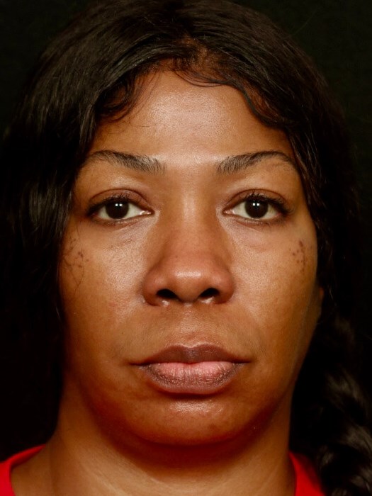 Rhinoplasty Before and After Before