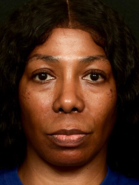 Rhinoplasty Before and After After