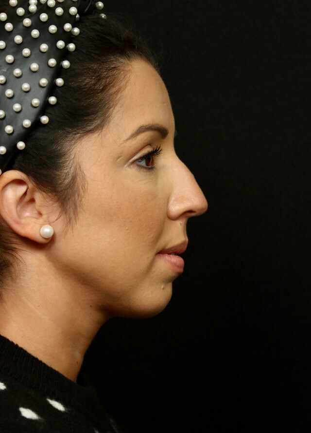 Rhinoplasty Before and After Before