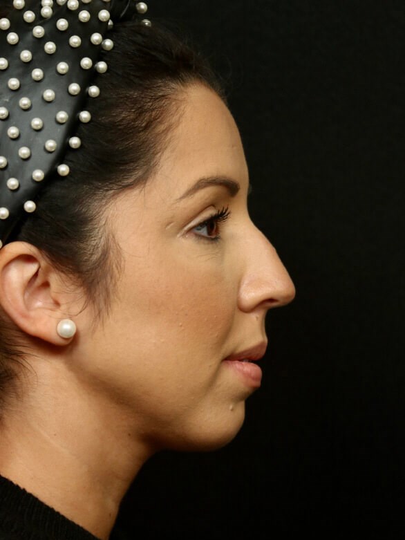 Rhinoplasty Before and After Before