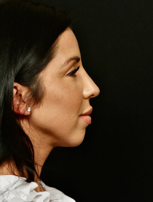 Rhinoplasty Before and After After