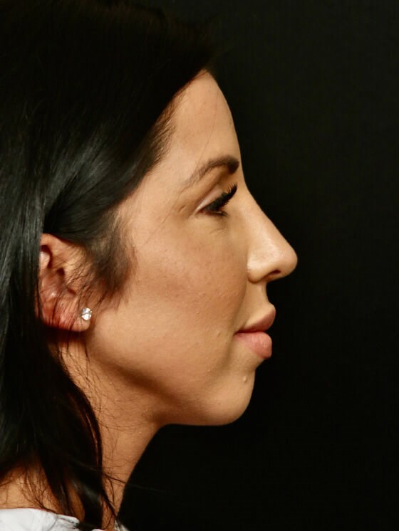 Rhinoplasty Before and After After