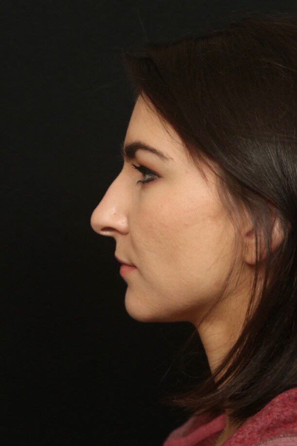 Rhinoplasty Before