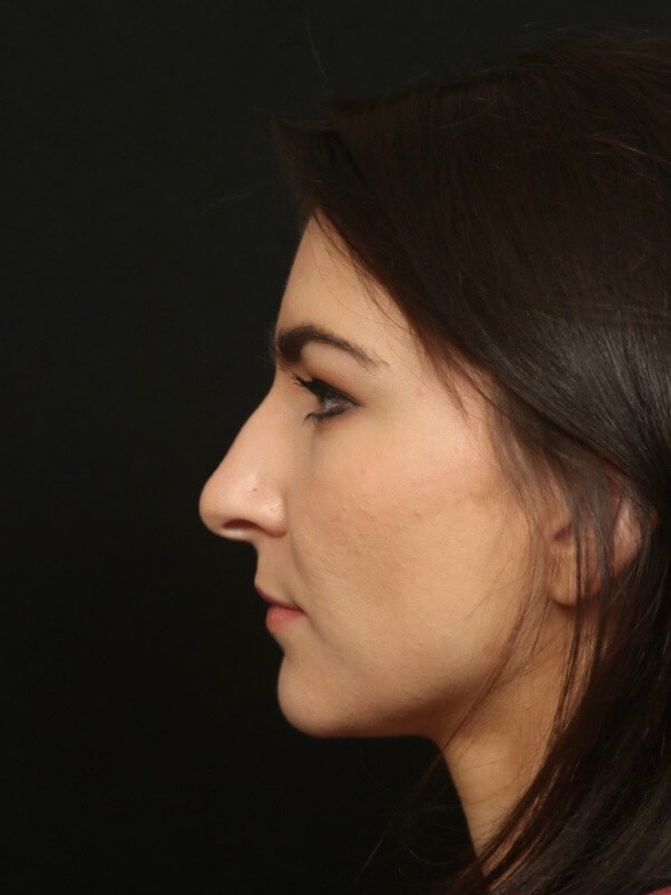 Rhinoplasty Before
