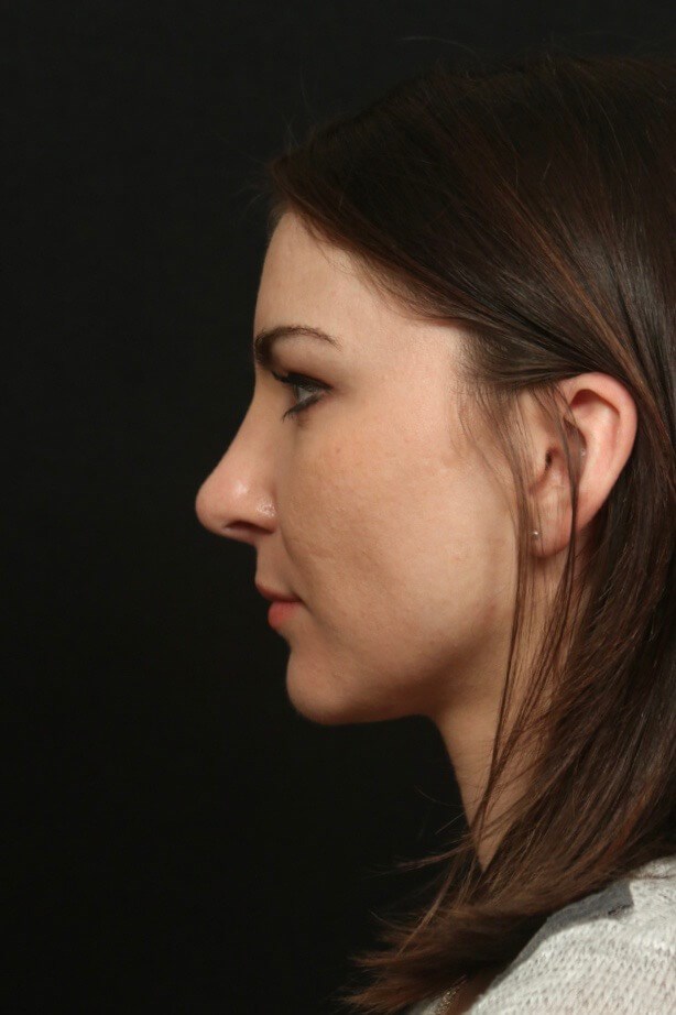 Rhinoplasty After