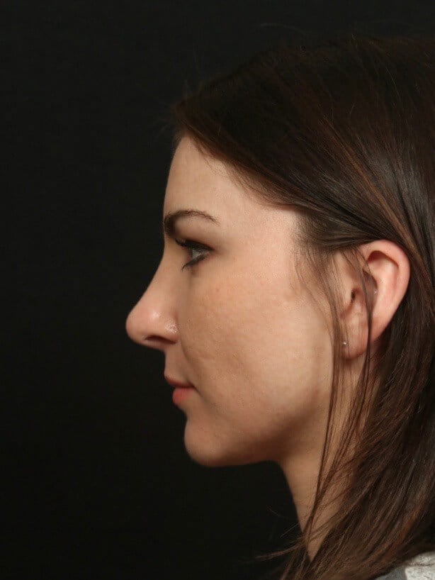 Rhinoplasty After