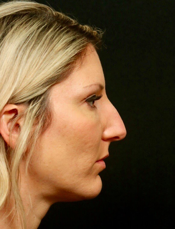 Rhinoplasty Before and After  Before