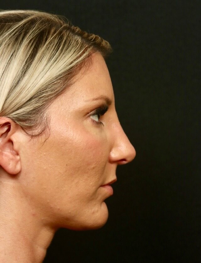 Rhinoplasty Before and After  After