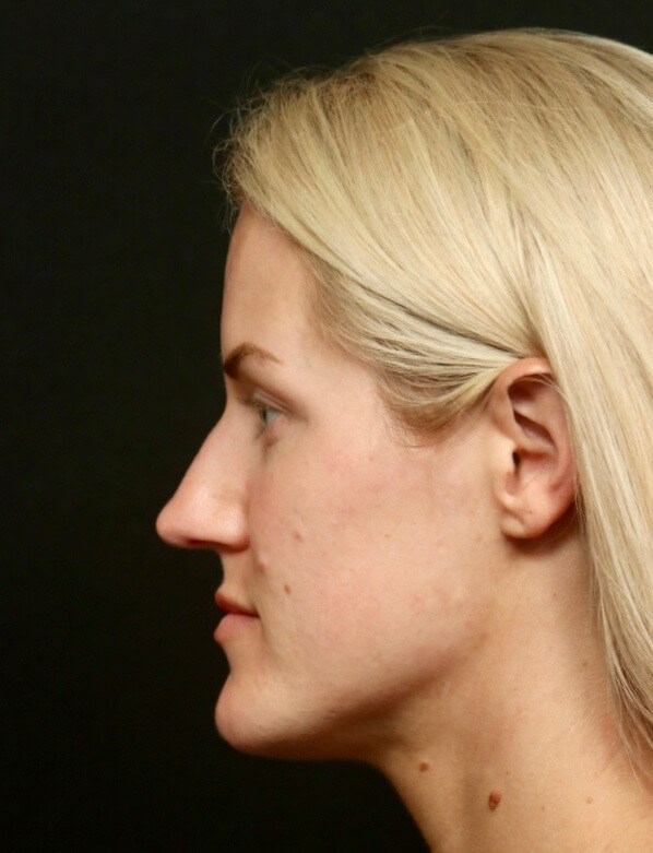 Rhinoplasty Before
