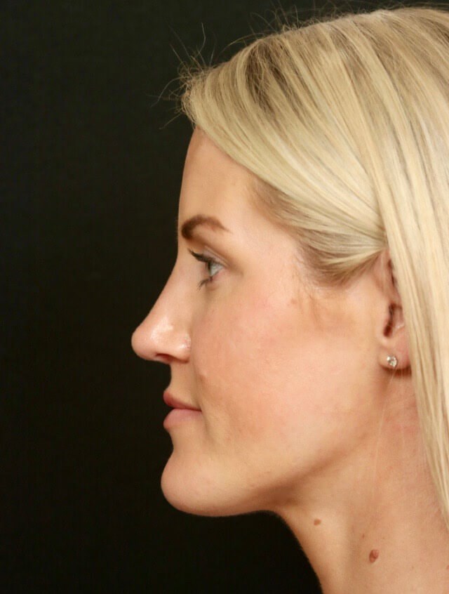 Rhinoplasty After