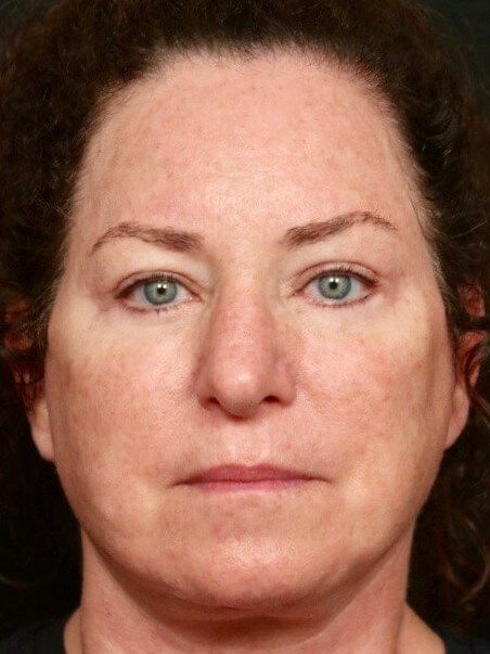 Facelift After