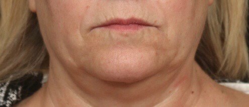 Lip Augmentation Pre/Post-Op Before