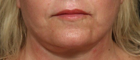 Lip Augmentation Pre/Post-Op After