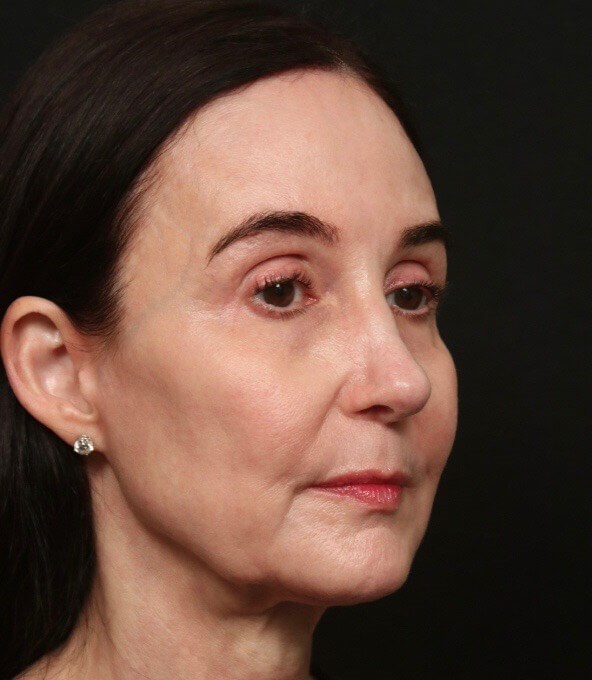 Mini Facelift Before and After Before