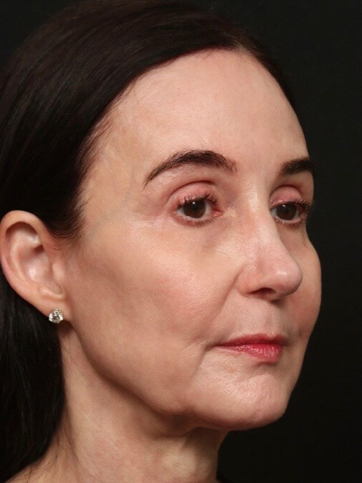 Mini Facelift Before and After Before