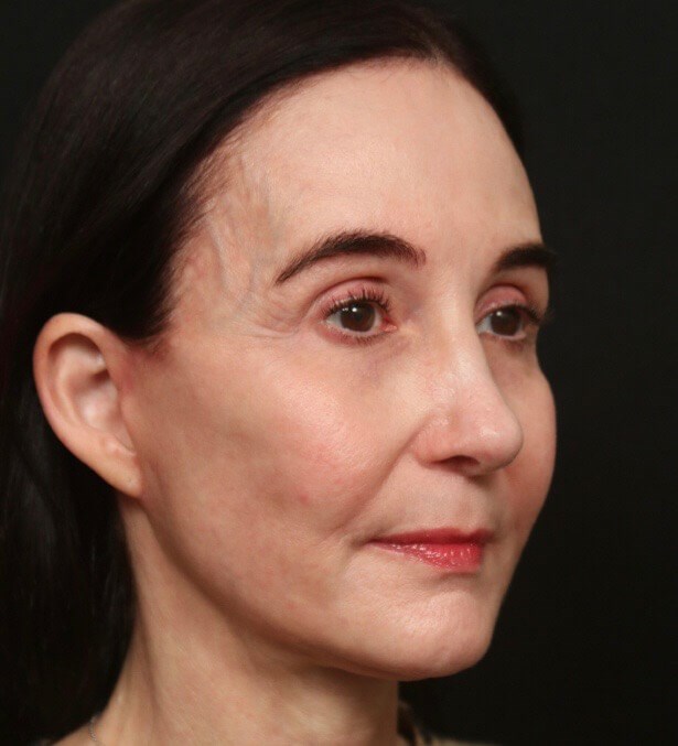 Mini Facelift Before and After After