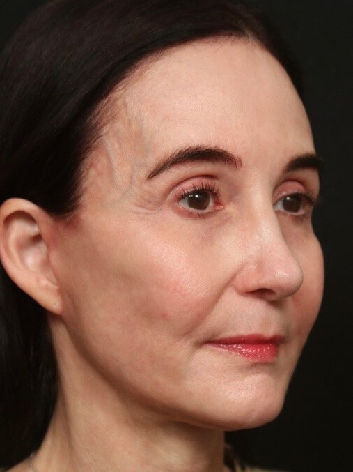 Mini Facelift Before and After After