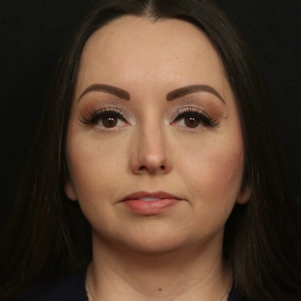 Rhinoplasty Front View Before