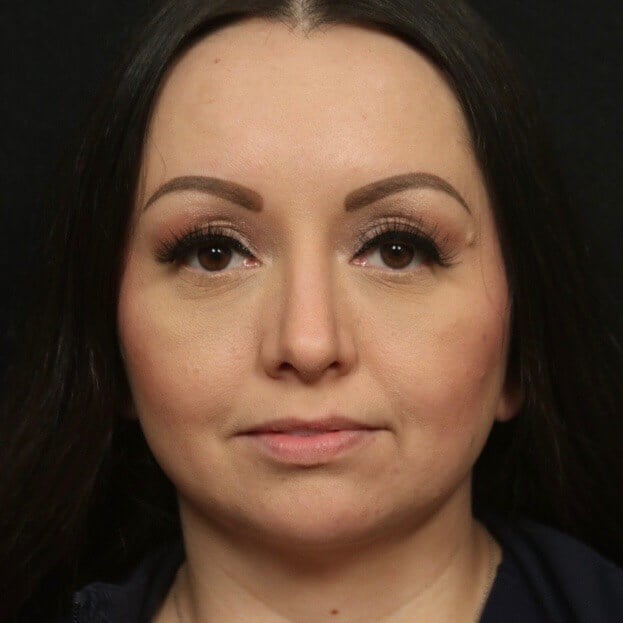 Rhinoplasty Front View After