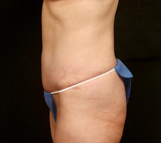 Tummy Tuck Before and After  After