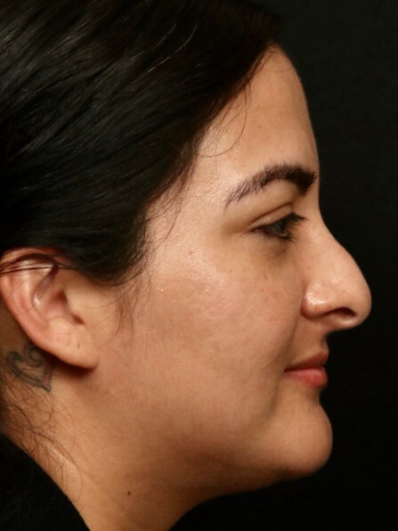 Rhinoplasty Before and After Before