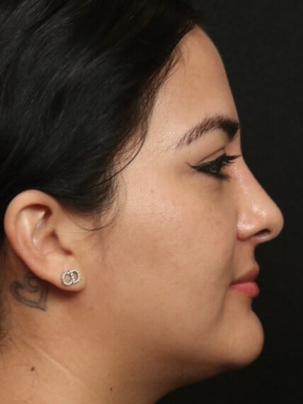 Rhinoplasty Before and After After