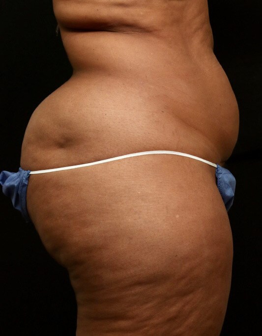 Tummy Tuck Before and After Before