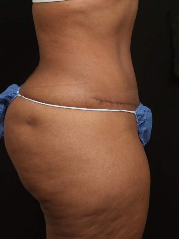 Tummy Tuck Before and After After
