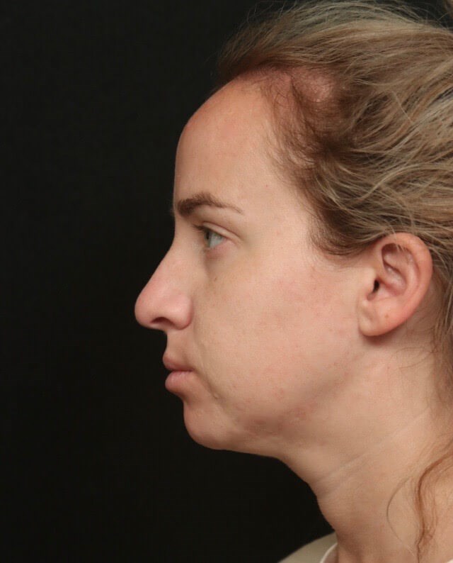 Before and After Rhinoplasty Before