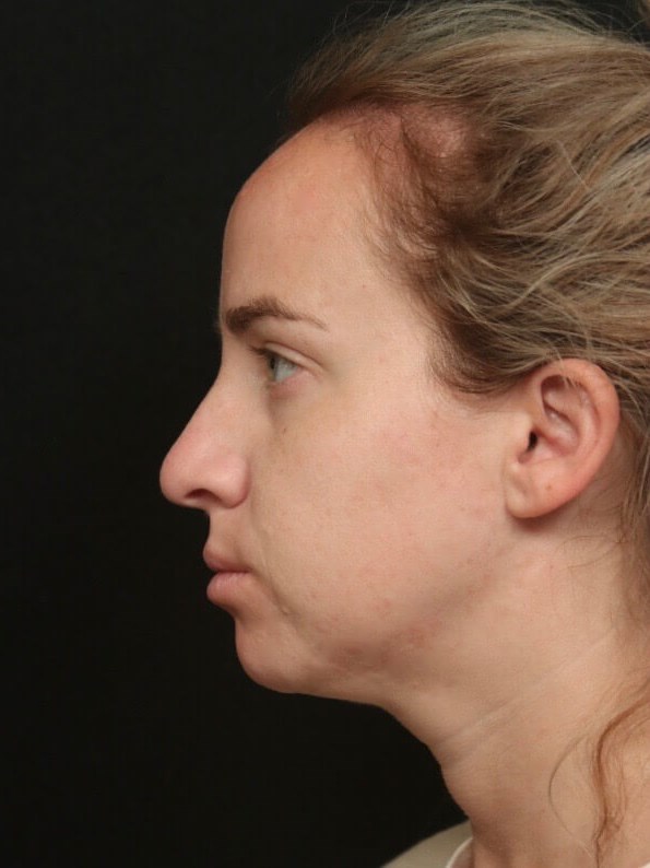 Before and After Rhinoplasty Before