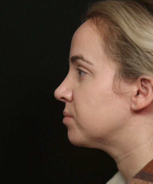 Before and After Rhinoplasty After
