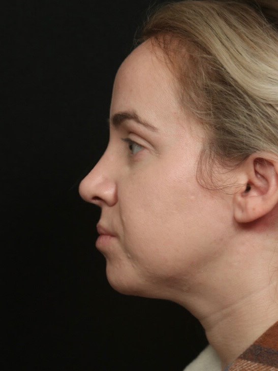 Before and After Rhinoplasty After